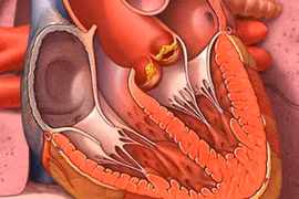 Mệt mỏi, sút cân, người đàn ông 47 tuổi phát hiện viêm nội tâm mạc