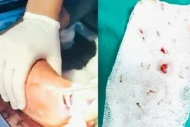 Hơn 30 con giòi bò lổm ngổm trong vết thương của cụ ông 