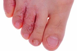Thời tiết nồm ẩm, cẩn thận bệnh nấm da 