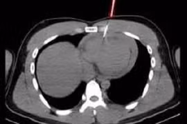Cứu sống nam thanh niên 21 tuổi bị thủng tim do máy bắn đinh