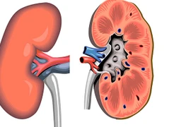 Viêm thận bể thận cấp nguy hiểm thế nào?