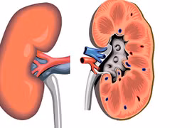 Viêm thận bể thận cấp nguy hiểm thế nào?