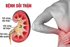 Thói quen xấu của dân văn phòng dễ gây sỏi thận