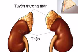 Lạm dụng thuốc giảm đau, bệnh nhân suy tuyến thượng thận