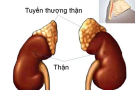 Lạm dụng thuốc giảm đau, bệnh nhân suy tuyến thượng thận