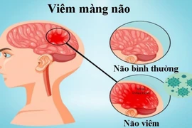Nhận biết triệu chứng viêm màng não ở trẻ em, chớ dại bỏ qua