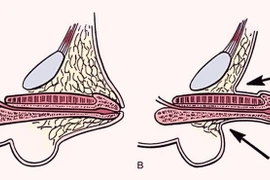 Bác sĩ chia sẻ cách điều trị vùi dương vật bẩm sinh ở trẻ