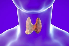 Lạm dụng mổ u tuyến giáp cẩn thận biến chứng nguy hiểm