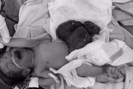 Bé trai sinh non 2,4 kg có nội tạng nằm ngoài ổ bụng