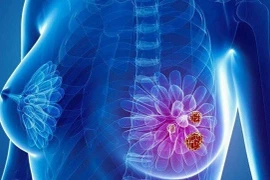 Thời điểm vàng để tầm soát ung thư vú