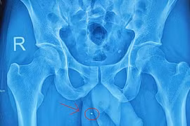 Nam thanh niên suýt mất “bản lĩnh đàn ông” vì... tai nạn lao động