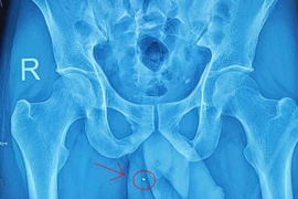 Nam thanh niên suýt mất “bản lĩnh đàn ông” vì... tai nạn lao động