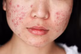 Thời tiết nồm ẩm dễ gây bệnh da liễu 