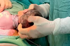 Cặp song sinh: Một dây rốn thắt nút, một 3 vòng rau quấn cổ