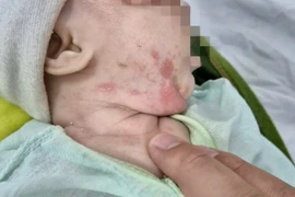 Bé trai loét khắp người vì mắc giang mai bẩm sinh