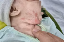 Bé trai loét khắp người vì mắc giang mai bẩm sinh