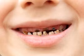 Trẻ sâu răng cẩn thận biến chứng viêm tủy răng gây nguy hiểm