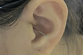 Cô gái thủng màng nhĩ vì bị va trúng khi đang lấy ráy tai