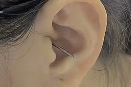 Cô gái thủng màng nhĩ vì bị va trúng khi đang lấy ráy tai