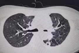 Hồi sinh lá phổi xẹp do di chứng nặng nề của bệnh lao phổi
