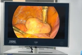 Bóc tách u bì buồng trứng có xương, tóc cho bệnh nhân 35 tuổi