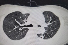 Hồi sinh lá phổi xẹp do di chứng nặng nề của bệnh lao phổi