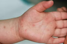 TP HCM ghi nhận 157 trường hợp mắc tay chân miệng tuần qua