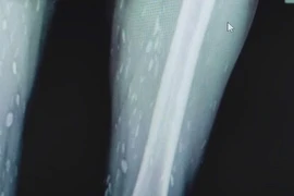 Sán chi chít từ chân tới não vì... sở thích ăn đồ sống