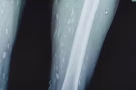 Sán chi chít từ chân tới não vì... sở thích ăn đồ sống