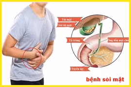 5 thói quen tưởng vô hại nhưng dễ gây sỏi mật