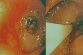 Bé trai 13 tuổi ói ra máu vì nhiễm khuẩn Helicobacter pylori