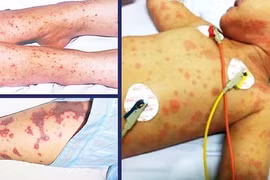 Dấu hiệu nhận biết sớm bệnh viêm não mô cầu