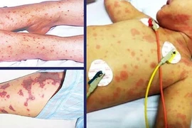 Dấu hiệu nhận biết sớm bệnh viêm não mô cầu