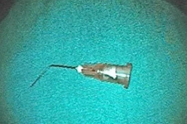 Bé trai 10 tuổi nuốt kim tiêm vào dạ dày khi đi chữa răng