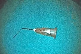 Bé trai 10 tuổi nuốt kim tiêm vào dạ dày khi đi chữa răng