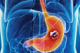 Dấu hiệu cảnh báo sớm ung thư dạ dày