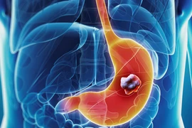 Dấu hiệu cảnh báo sớm ung thư dạ dày