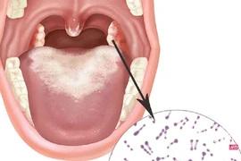 Phân biệt bệnh bạch hầu họng với các chứng viêm họng, amidan