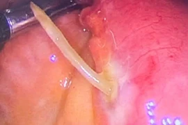 Người phụ nữ 61 tuổi bị xương cá xuyên thủng thành ruột non