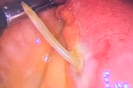 Người phụ nữ 61 tuổi bị xương cá xuyên thủng thành ruột non