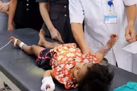 Bé gái ngã vào chậu nước sôi bỏng nặng, cách sơ cứu bỏng nhiệt