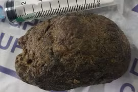 Tắc ruột sau khi ăn 3 quả hồng ngâm phải nhập viện cấp cứu