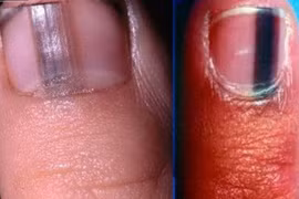 Ngón chân đen đầu, đi khám phát hiện ung thư tế bào hắc tố