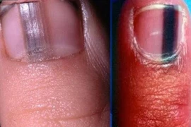 Ngón chân đen đầu, đi khám phát hiện ung thư tế bào hắc tố