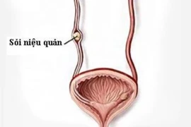 Biến chứng khó lường của sỏi niệu quản, cách phòng tránh