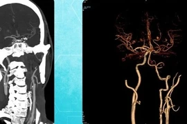 Đột nhiên yếu nửa người, mất ngôn ngữ do nhồi máu não