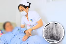 Người phụ nữ bị bỏng nặng vì gặp sự cố khi giác hơi