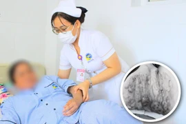 Người phụ nữ bị bỏng nặng vì gặp sự cố khi giác hơi