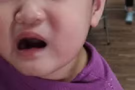 Bé 2 tuổi méo miệng, liệt dây thần kinh số 7 do trời rét đậm