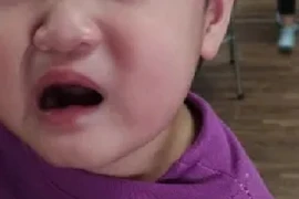 Bé 2 tuổi méo miệng, liệt dây thần kinh số 7 do trời rét đậm